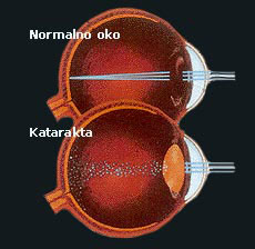 Siva mrena (katarakta) Siva mrena (katarakta)